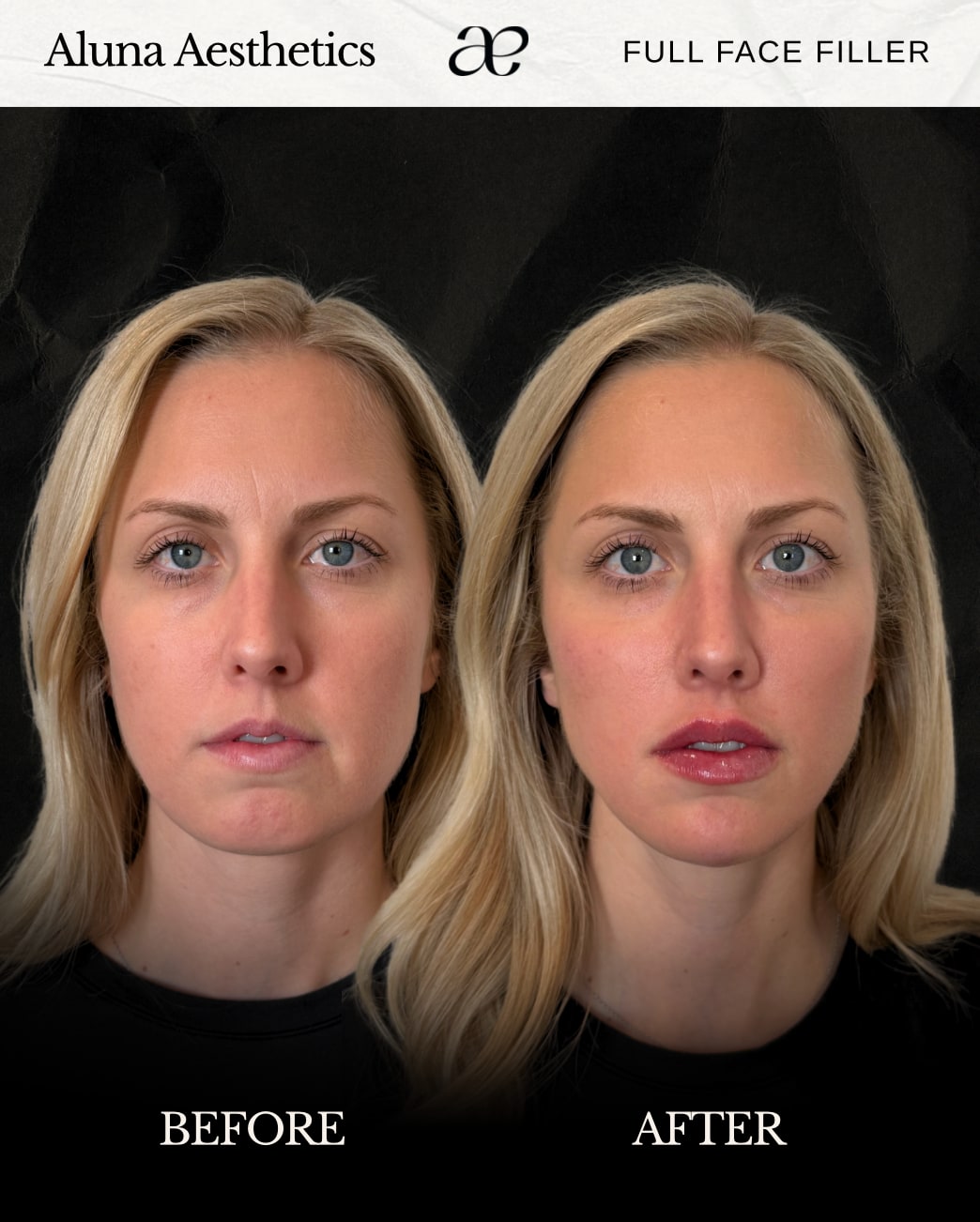 Full Face Filler before and after at Aluna Aesthetics