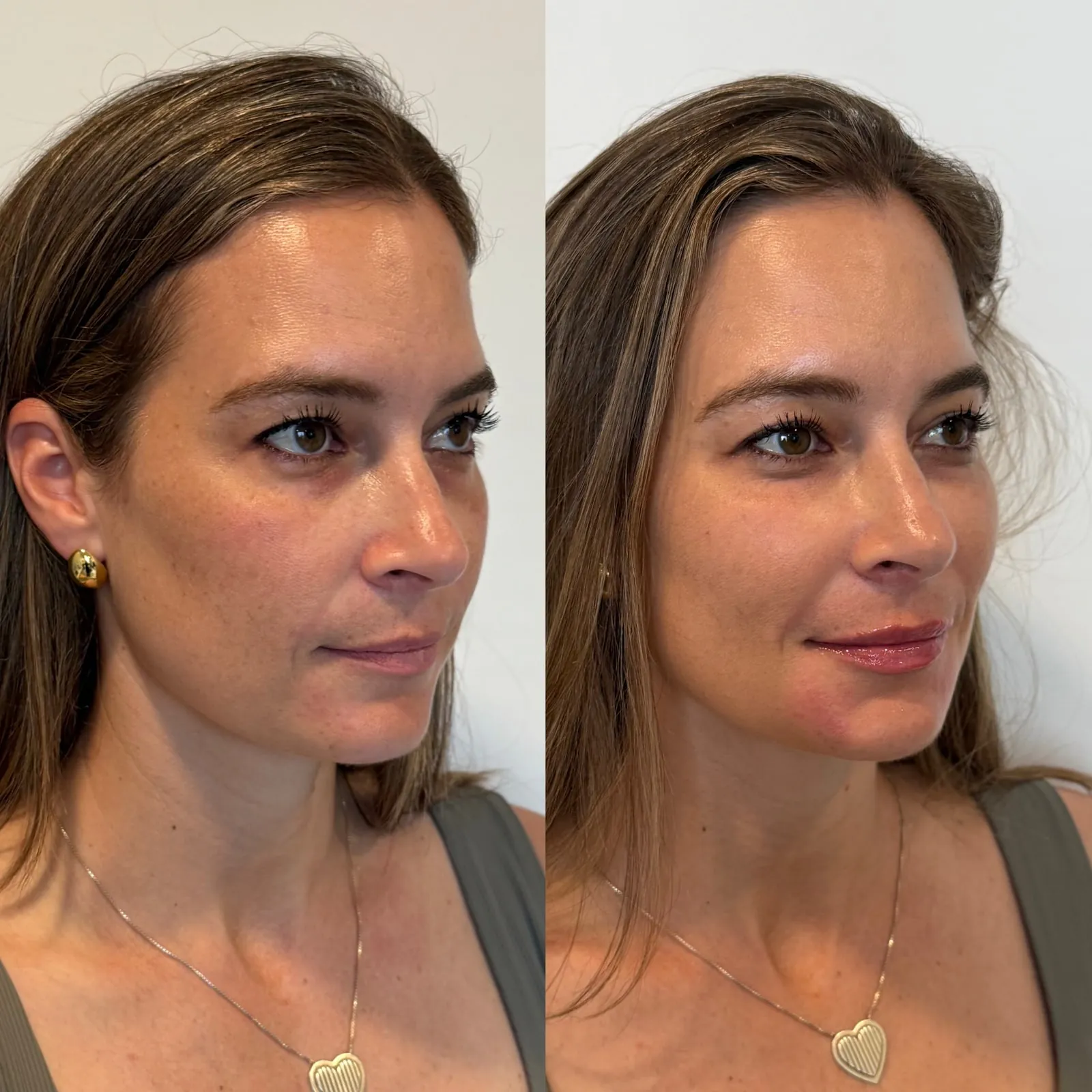 Cheek & Lip Filler before and after at Aluna Aesthetics