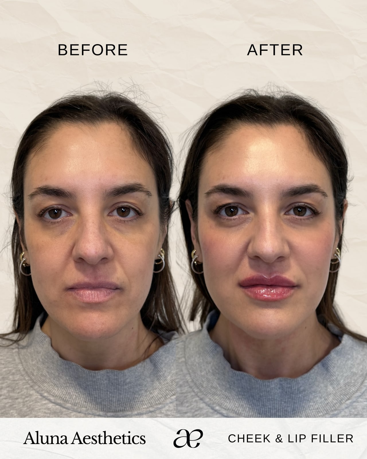 Cheek & Lip Filler before and after at Aluna Aesthetics