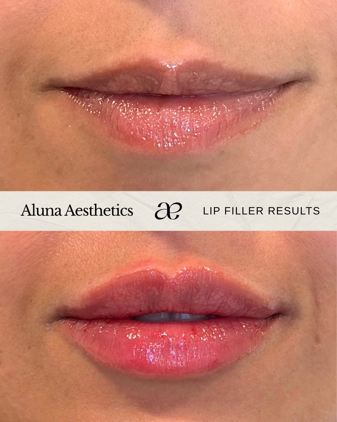 Lip Filler before and after at Aluna Aesthetics