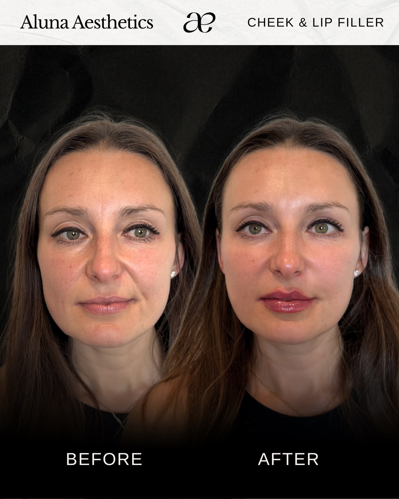 Cheek & Lip Filler before and after at Aluna Aesthetics