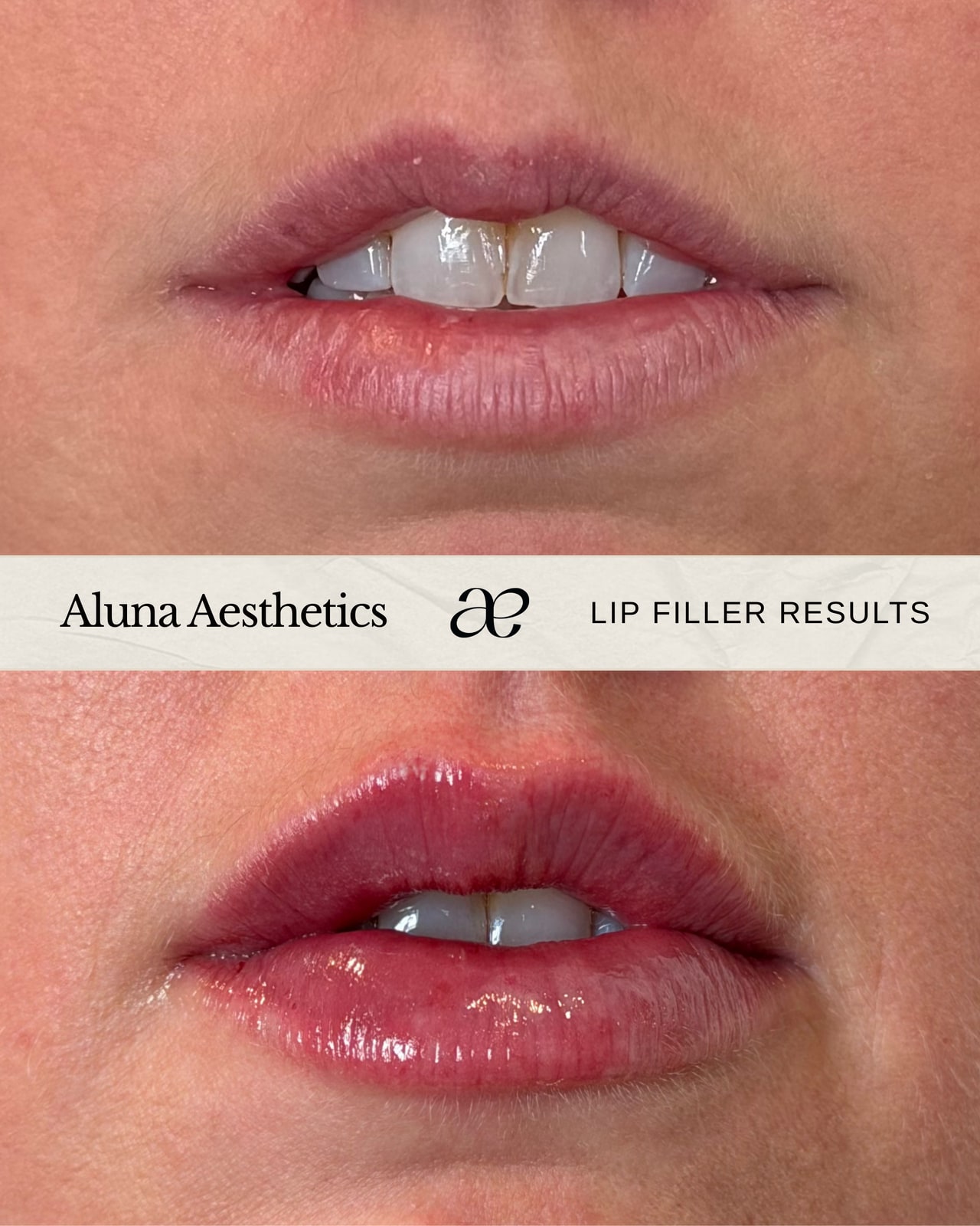 Lip Filler before and after at Aluna Aesthetics