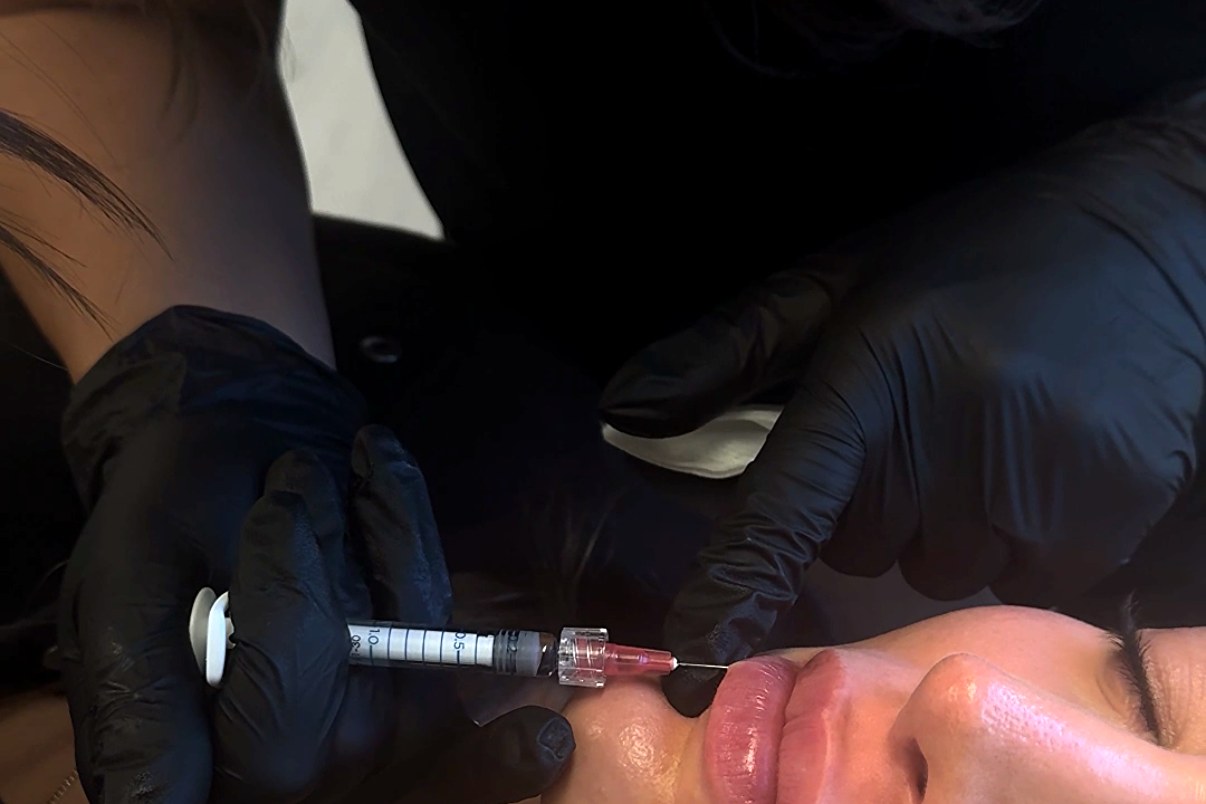 Dermal Fillers at Aluna Aesthetics