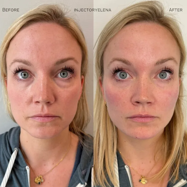 Dermal Filler - Cheeks, Chin, Jaw before and after at Aluna Aesthetics in Potomac, MD