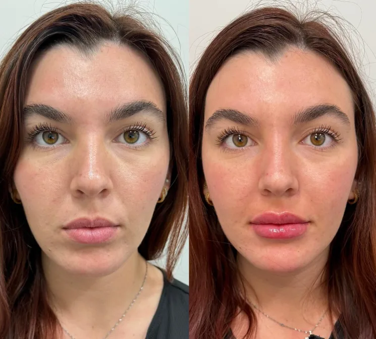 Dermal Filler - Lip + Chin Combo before and after at Aluna Aesthetics in Potomac, MD