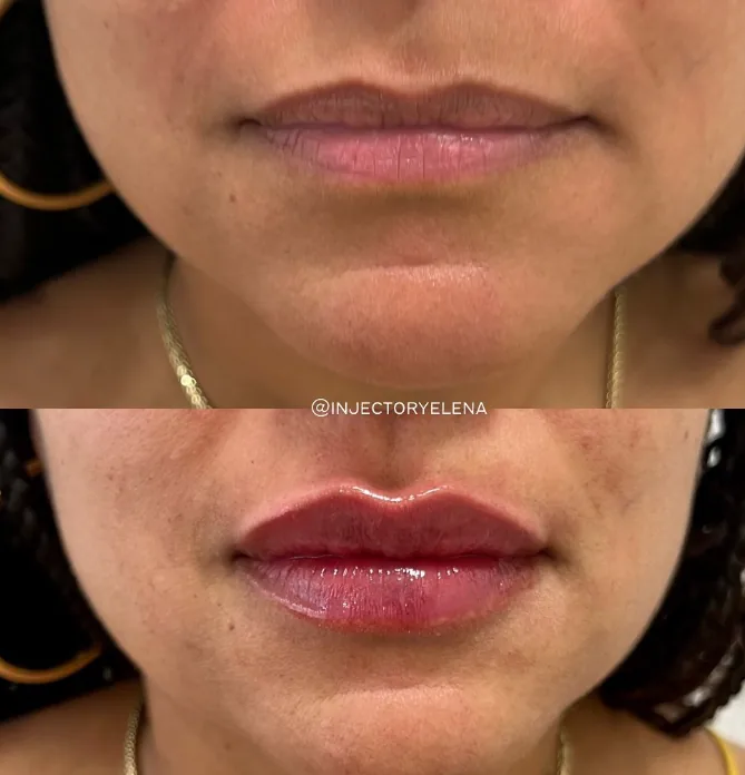 Lip Filler before and after at Aluna Aesthetics in Potomac, MD