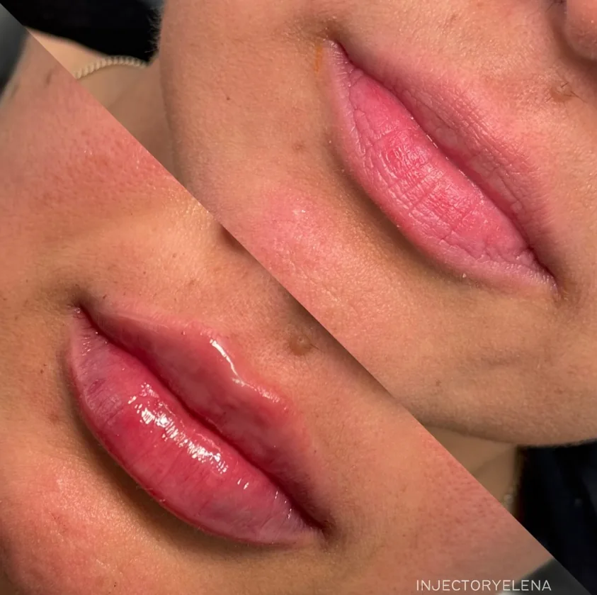 Lip Dermal Filler before and after at Aluna Aesthetics in Potomac, MD
