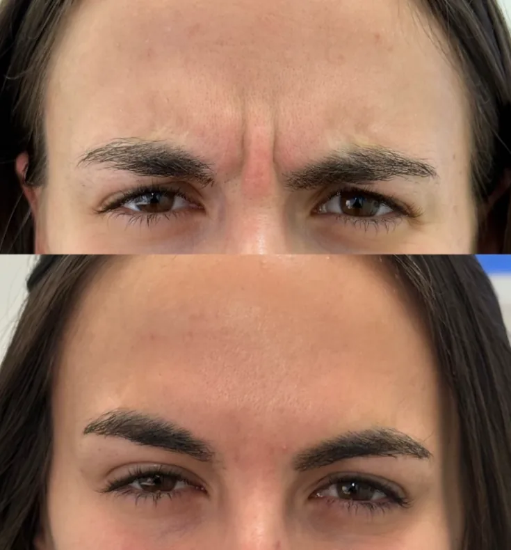 Botox before and after at Aluna Aesthetics in Potomac, MD