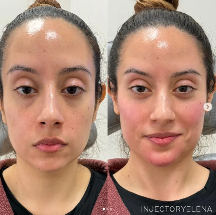 Facial Balancing before and after at Aluna Aesthetics in Potomac, MD